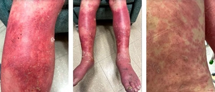 צילום: באדיבות Dr. FNU Nutan with VCU Health התגובה האלרגית לחיסון